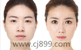 春节去韩国做韩式双眼皮手术