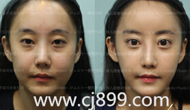寒假去韩国做脸部轮廓手术
